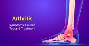 Arthritis Doctor In Pune