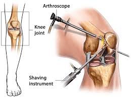 Best Arthroscopy Hospital In Pune