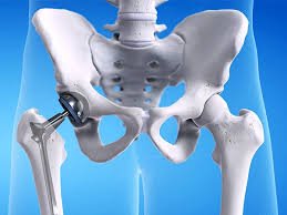 Best Hip Replacement In Pune