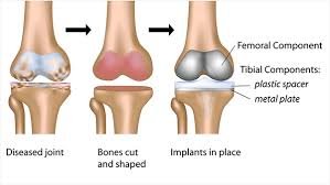 Best Joint Replacement In Pune