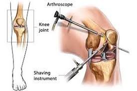 Best Knee Arthroscopy In Pune