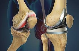 Best Knee Replacement In Pune
