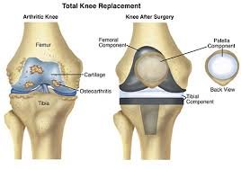 Best Knee Replacement Surgeon In Pune