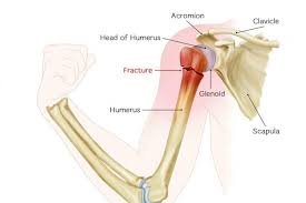 Best Shoulder Fracture In Pune