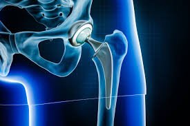 Hip Replacement In Pune