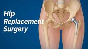 Hip Replacement Surgery In Pune