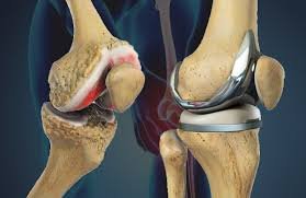 Joint Replacement In Pune