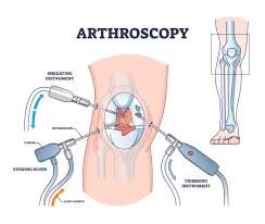 Knee Arthroscopy Surgery In Pune