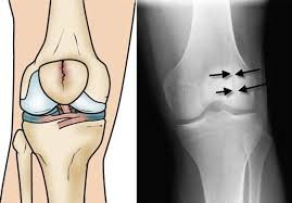 Knee Fracture In Pune