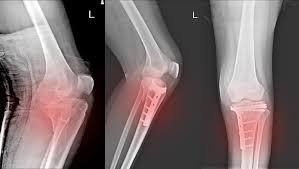 Knee Fracture Surgery In Pune
