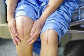 Knee Replacement In Pune