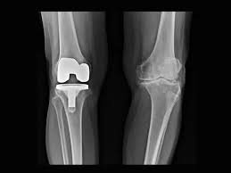 Knee Replacement surgery Cost In Pune