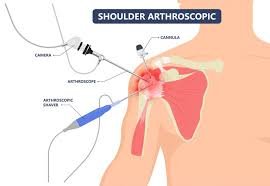 Shoulder Arthroscopy In Pune