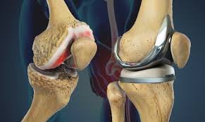 Top Knee Replacement Surgeon In Pune